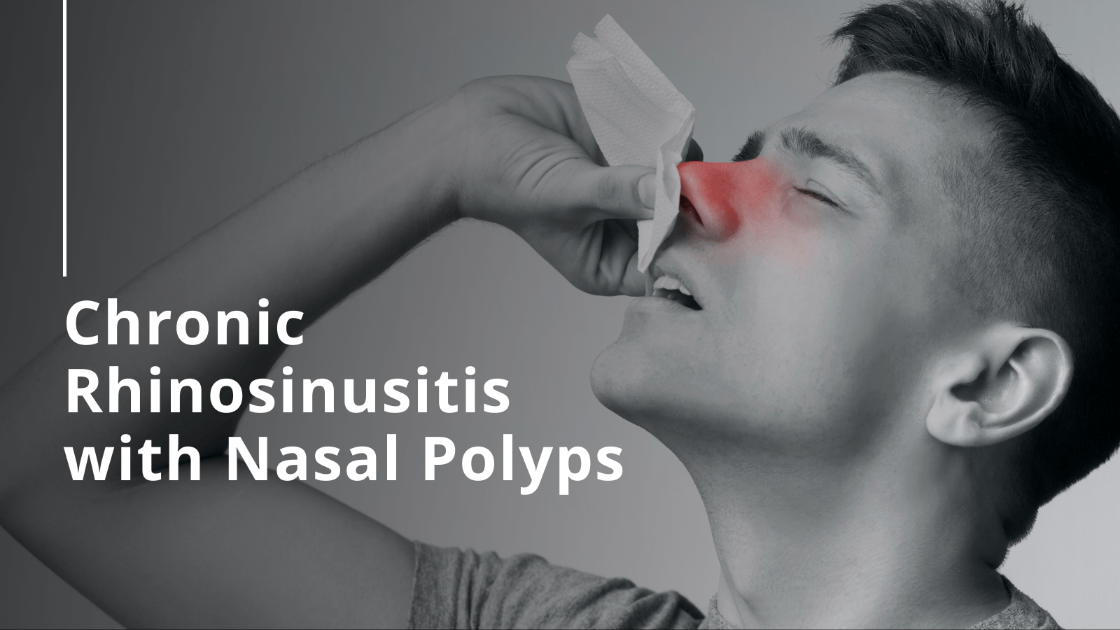 Chronic Rhinosinusitis with Nasal Polyps (CRSwNP)_2