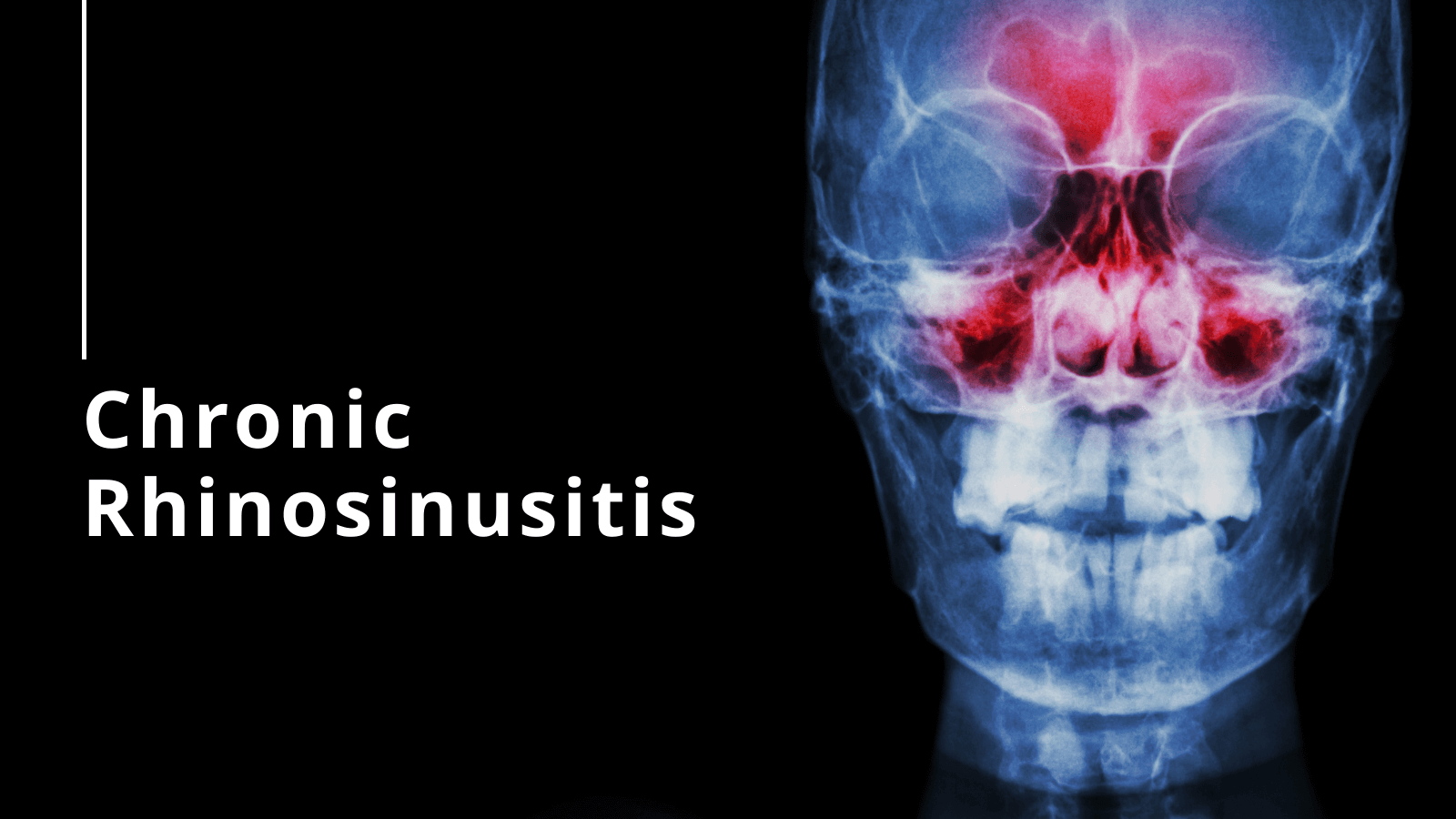 Chronic Rhinosinusitis_1