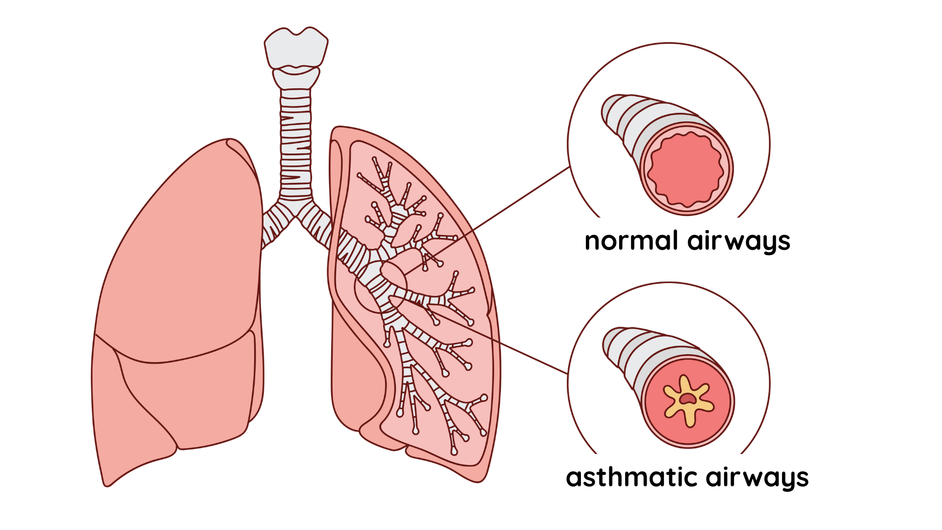 Airways - normal and asthmatic