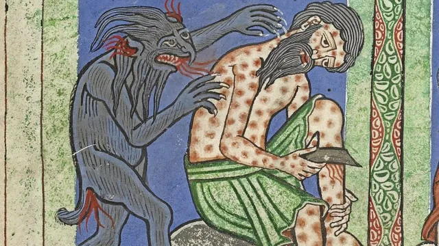 Leprosy's surprising history unfolds from blessing to stigma
