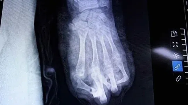 Teenage boy suffers severe hand injuries from homemade fireworks in Vietnam