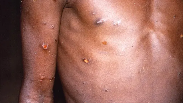 Mpox And Mask Bans - A Recipe For Disaster