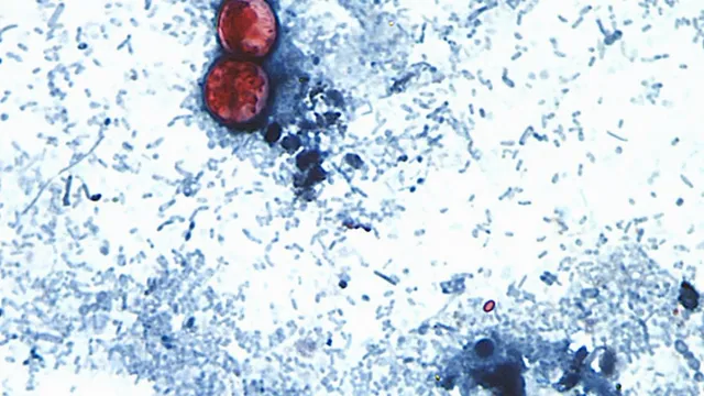 Michigan reports two deaths linked to cyclospora outbreak