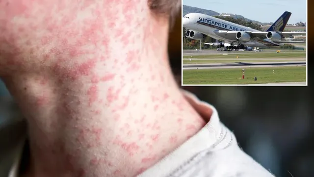 Measles outbreak looms as two travelers return to Perth from Singapore