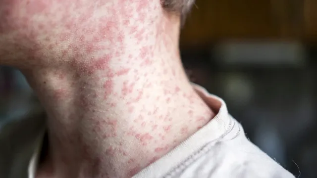 Measles outbreak spreads as hundreds of unvaccinated students are quarantined