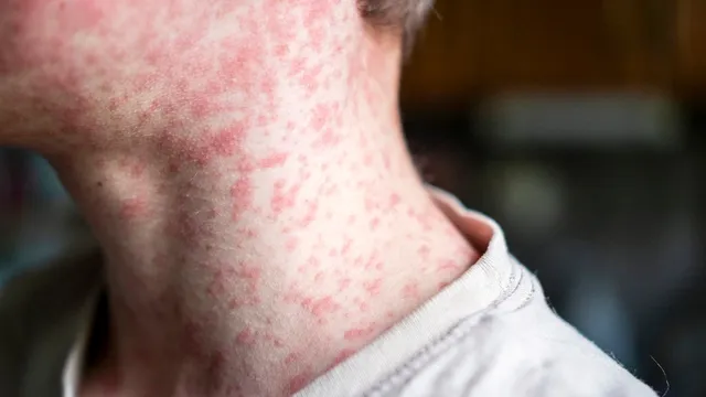 Low vaccination rates fuel rising measles outbreaks in London