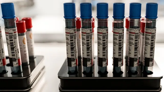 Patients demand Alzheimer's blood tests despite doctors' skepticism