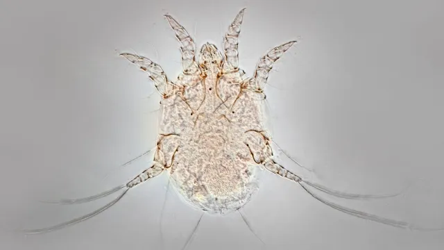 Scabies outbreak surges in the UK and Europe