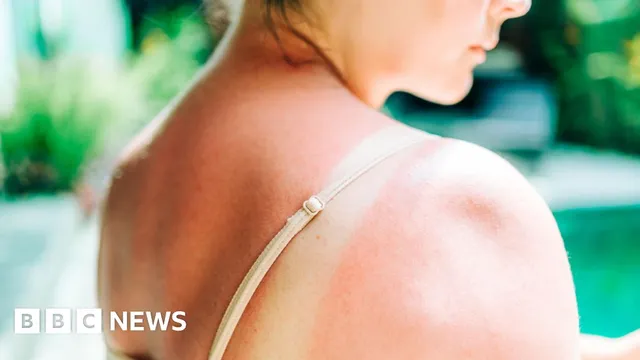 UK faces record high of melanoma cases as prevention awareness rises