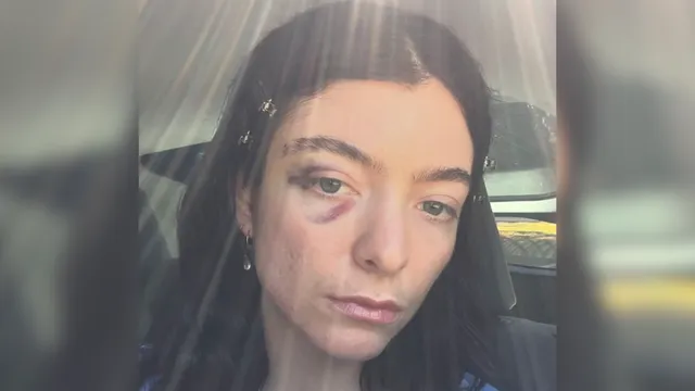 Lorde shares puzzling selfie with black eye on Instagram
