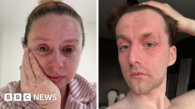 Growing awareness leads to research funding for mystery skin condition