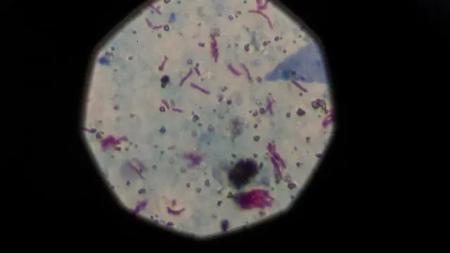 Malaysia faces alarming rise with ten active TB clusters identified