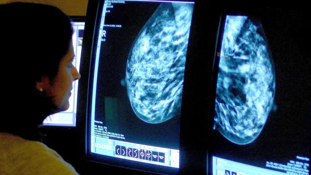 AI-supported screenings reduce aggressive breast cancer cases significantly