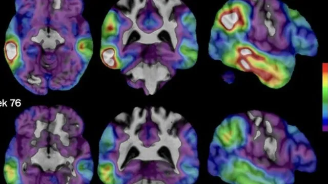 Biogen's new drug shows promise in slowing Alzheimer's decline