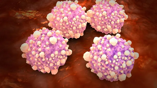 New blood test improves pancreatic cancer detection rates significantly