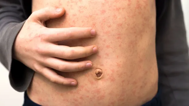 Measles outbreak infects over 60 children in north London schools