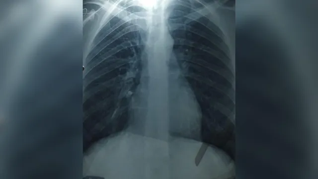 Man suffers from unusual hiccups after tooth aspiration during surgery