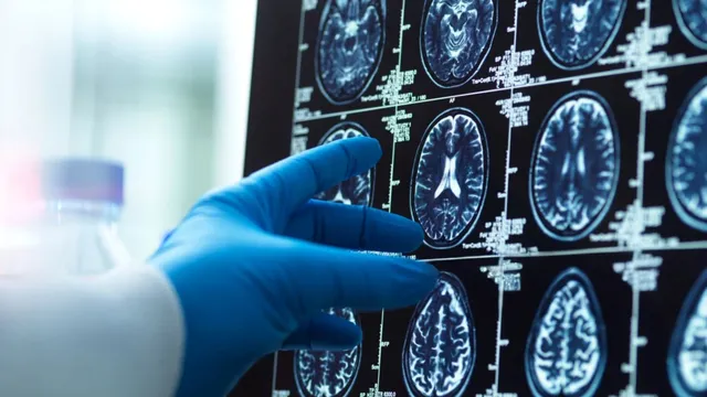 University of Minnesota researchers uncover early signs of Alzheimer's disease