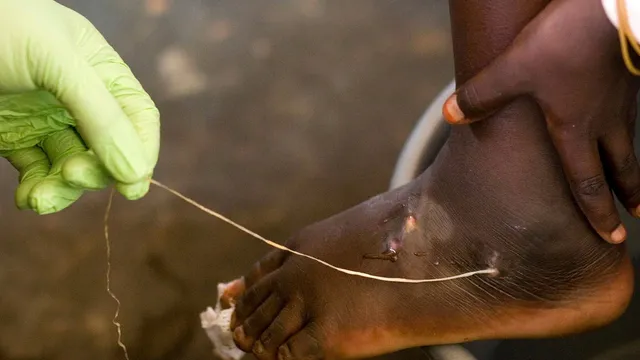Guinea worm cases drop to historic low under the Carter Center