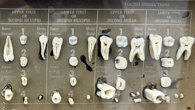 Utah braces for dental crisis after statewide fluoride ban