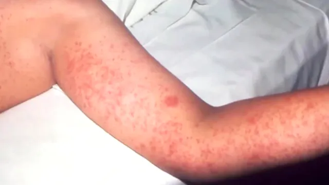 Vaccinated woman contracts measles in Dallas County outbreak