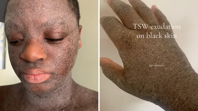 Young woman faces amputation after struggling with chronic pain