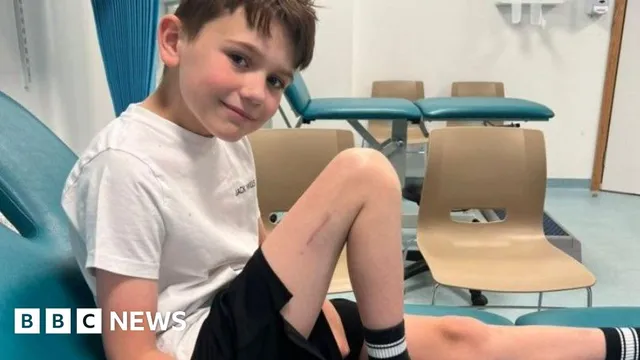 Alfie Phillips makes history with pioneering leg-lengthening surgery