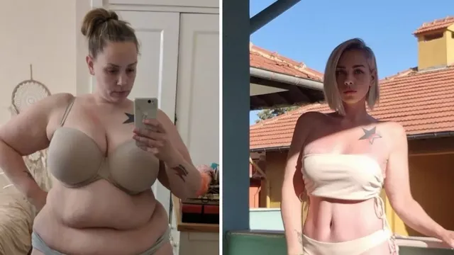 Woman Transforms Life After Weight Loss Journey and Surgery in Lithuania