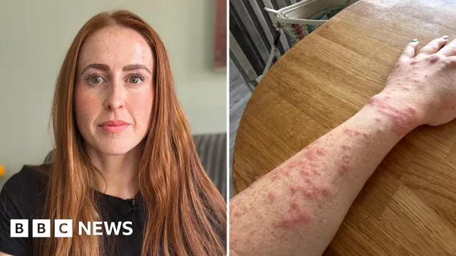 Woman suffers bed bug bites during Travelodge stay