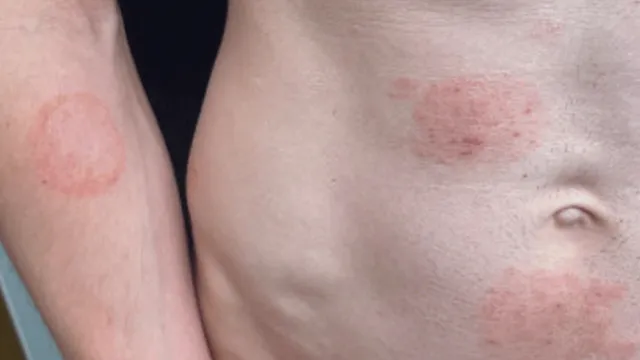 Minnesota faces outbreak of sexually transmitted ringworm infections