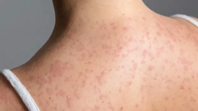 Pittsburgh braces for potential measles outbreak as vaccination rates drop