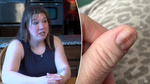 TikTok video aids woman’s early cancer diagnosis