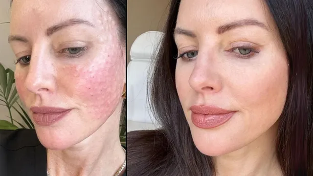 Salmon Sperm Facial: Beauty Trend or Risky Treatment?