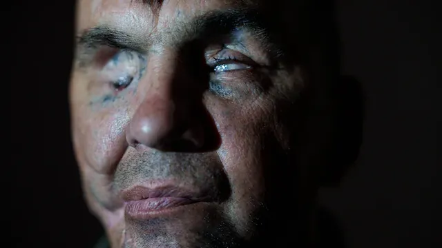 Ukrainian soldier blinded by mine undergoes surgery in Kyiv to regain sight