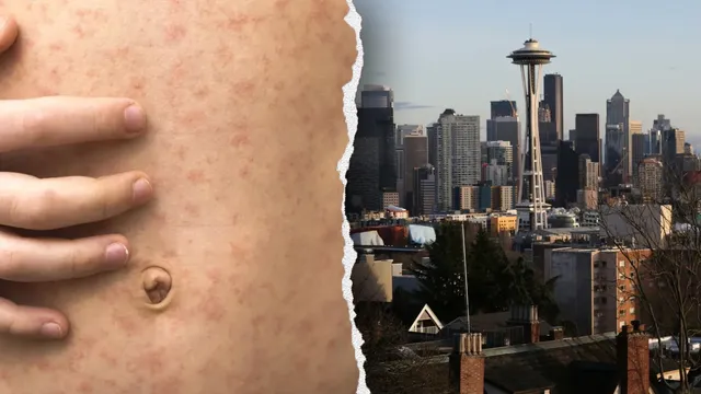 Canadian traveler infected with measles visits multiple venues in Washington