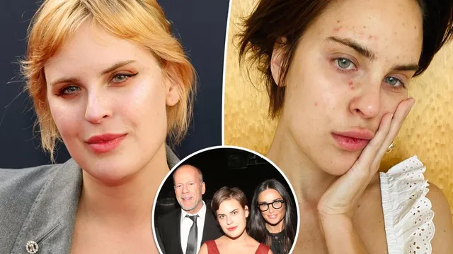 Tallulah Willis Opens Up About Skin Picking Struggle