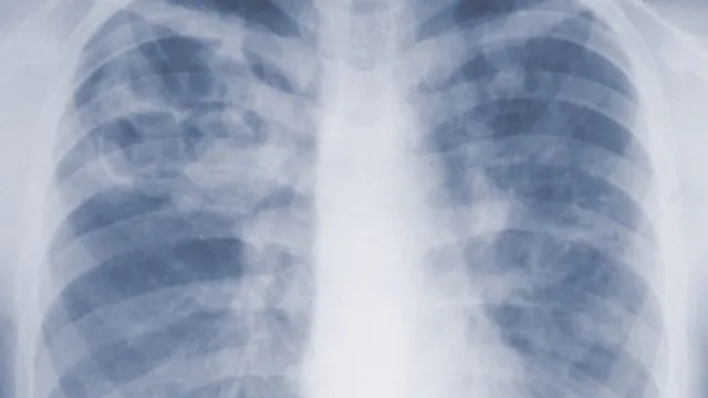 CDC study reveals invasive mold infections are deadlier than previously thought