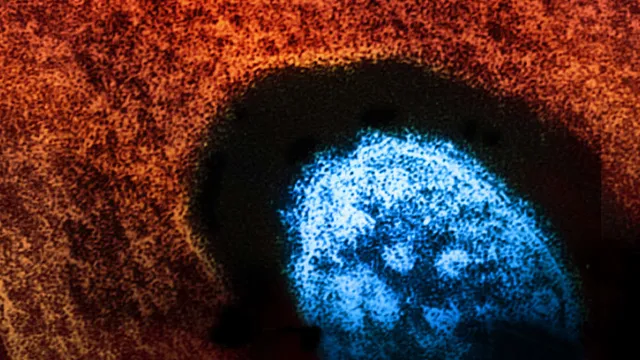 Ohio reports 10 measles cases linked to unvaccinated individuals