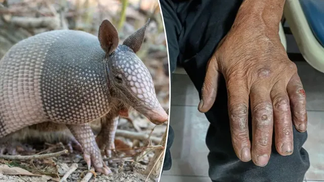 Florida sees rise in leprosy cases linked to armadillos