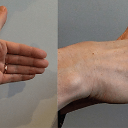 Figure 4. Raising the cone gesture